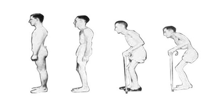 贵阳强直医院专家解答:强直患者的诊断治疗方法 贵阳强直医院专家解答:强直患者的诊断治疗方法