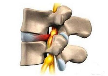 什么原因会导致强直性脊柱炎 什么原因会导致强直性脊柱炎