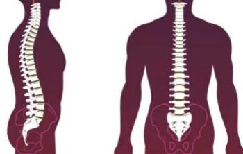 强直性脊柱炎如何确诊 到医院作相关检查确诊 强直性脊柱炎如何确诊 到医院作相关检查确诊