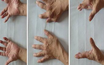 强直性脊柱炎的临床病因归结说明 强直性脊柱炎的临床病因归结说明.jpg