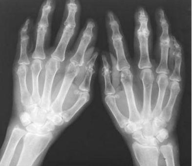 贵阳强直风湿病医院怎么样?类风湿性关节炎的病理表现有哪些